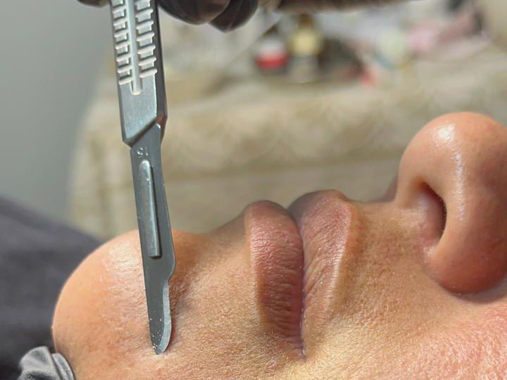 Esteticista con guantes pasando el bisturí por el mentón, tratamiento de dermaplaning