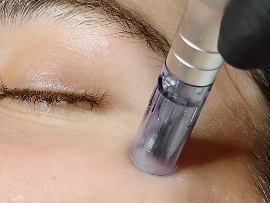 Dermapen aplicado sobre la piel junto al ojo, tratamiento facial con exosomas