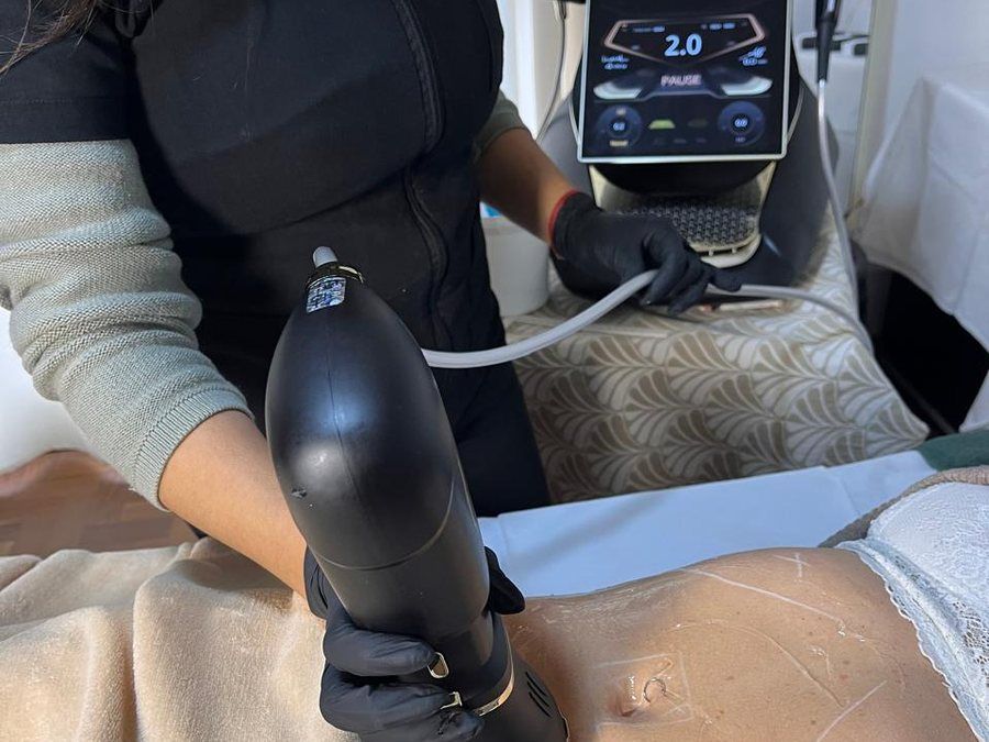 Esteticista aplicando el cabezal de Hifu corporal sobre el abdomen en KALON