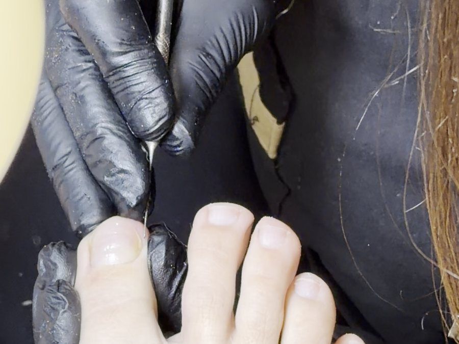 Podóloga con guantes tratando una uña encarnada del pie en KALON
